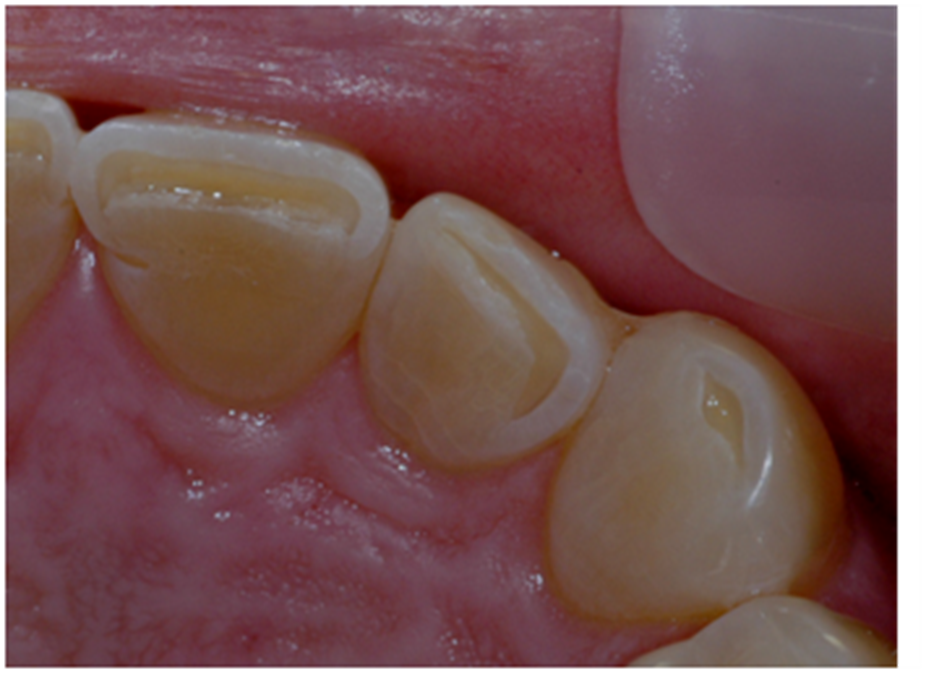 INCISAL EXCURSIVE Peter Walford Dentistry