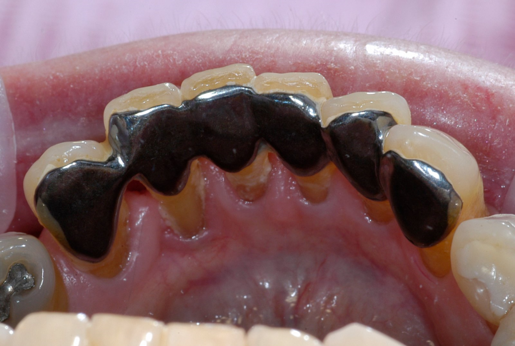 PERIODONTAL SPLINTS MULTIPLE ABUTMENT INLAYFLANGE SPLINTS Peter