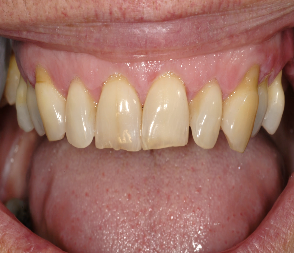 INCISAL MAXILLARY LINGUOINCISAL Peter Walford Dentistry