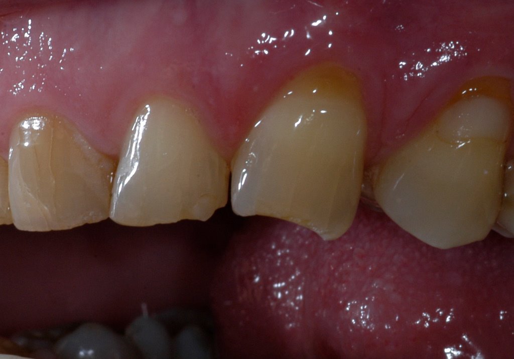 ETIOLOGY OF INCISAL ATTRITION Peter Walford Dentistry