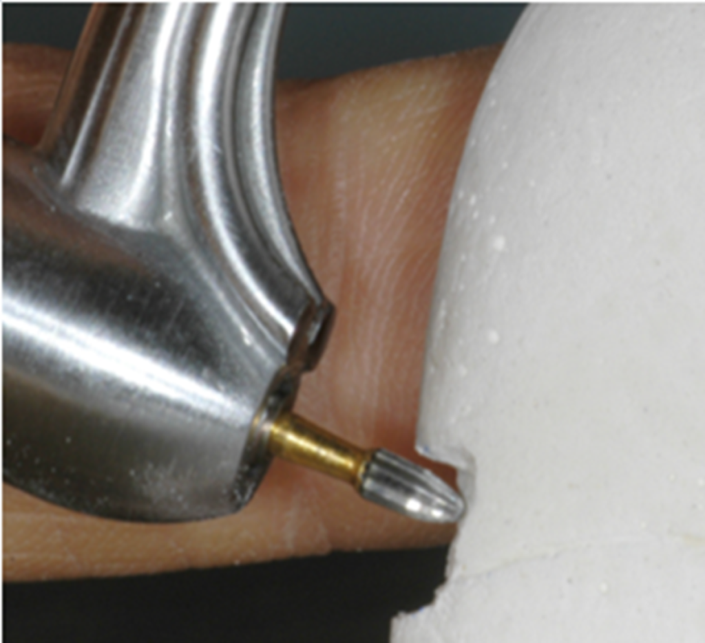 CAVOSURFACE BEVELS WITH 7404 AND 7406 BURS Peter Walford Dentistry