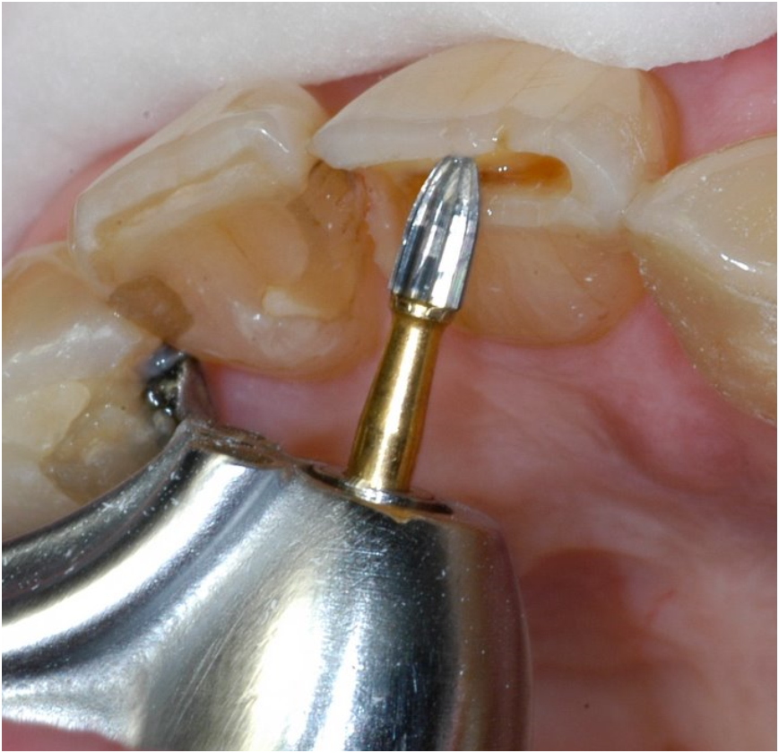 CAVOSURFACE BEVELS WITH 7404 AND 7406 BURS Peter Walford Dentistry
